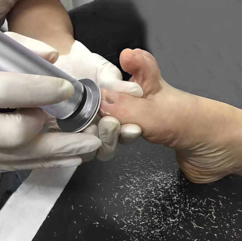 SoleSmooth Professional Electric Callus Remover – Perfect Gift for Silky Smooth Feet